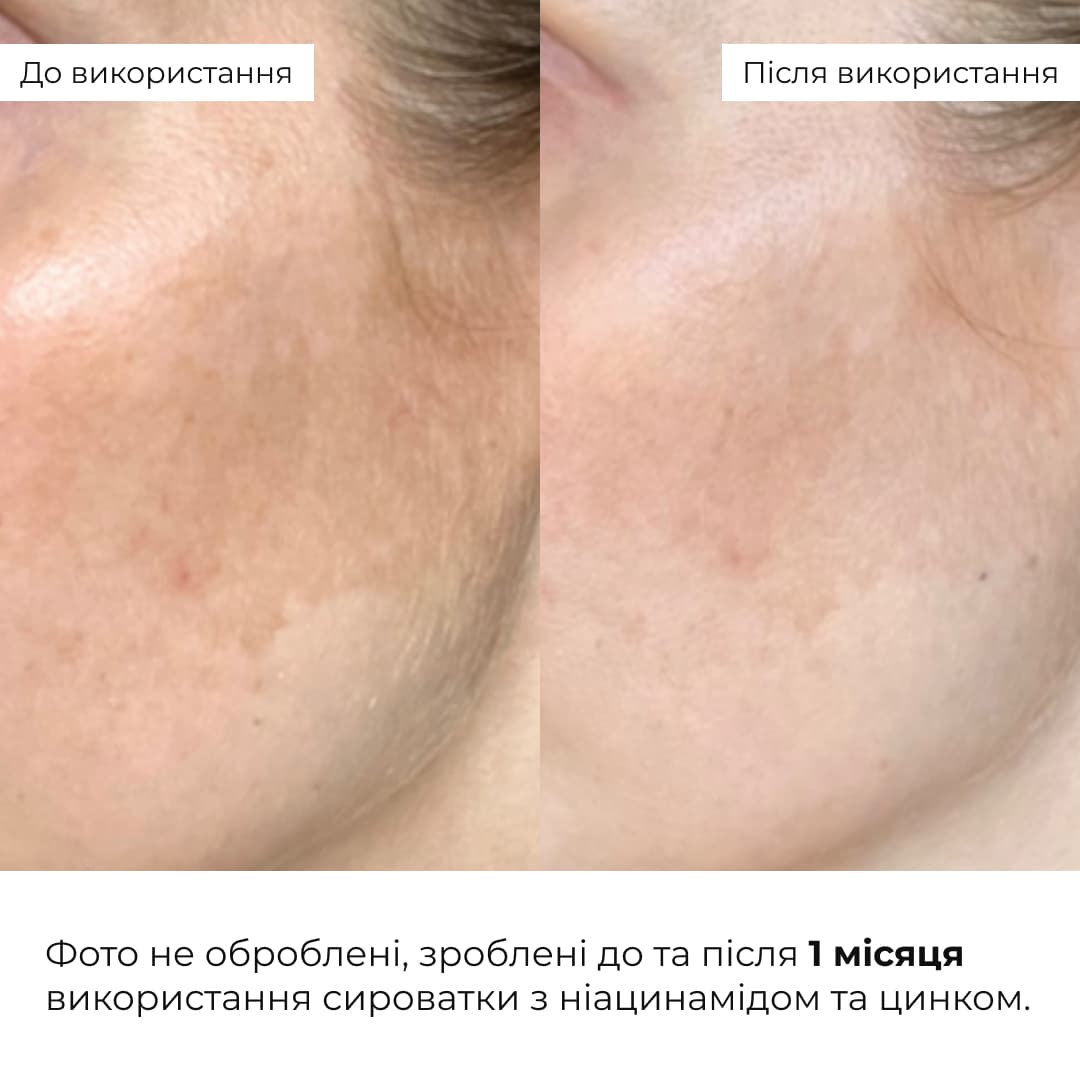 Комплекс для відновлення тону та захисту від пігментації SPF 30 thumbnail