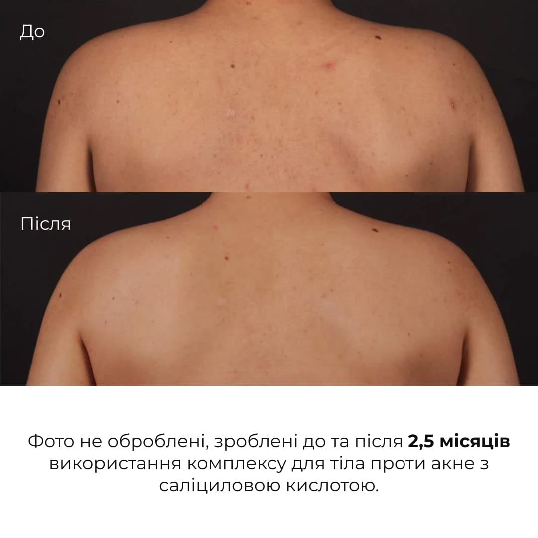 Комплекс проти висипань на тілі та глибокого живлення thumbnail