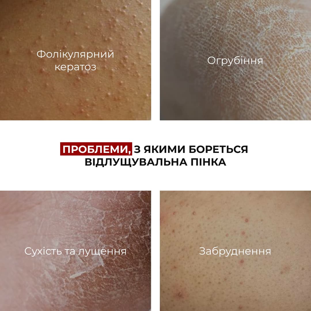 Комплекс для відлущування та корекції висипань на тілі thumbnail