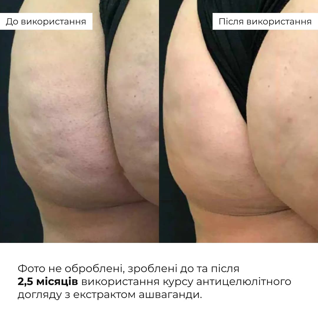 Курс антицелюлітного догляду в домашніх умовах з ашвагандою thumbnail
