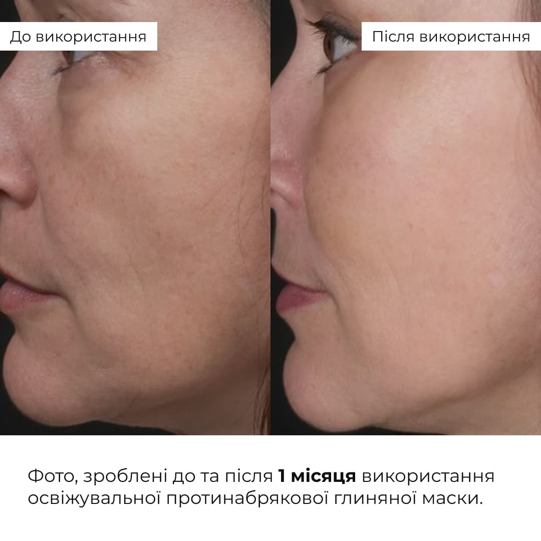 Комплекс глиняних масок для ліфтингу шкіри та зменшення набряків thumbnail