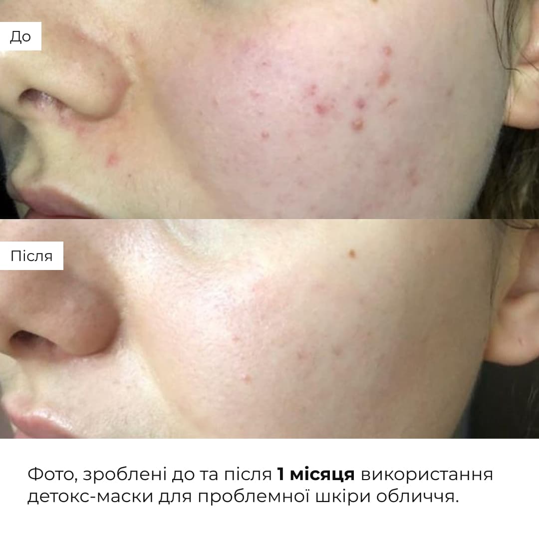 Комплекс глиняних масок для детоксикації та відновлення пружності шкіри thumbnail