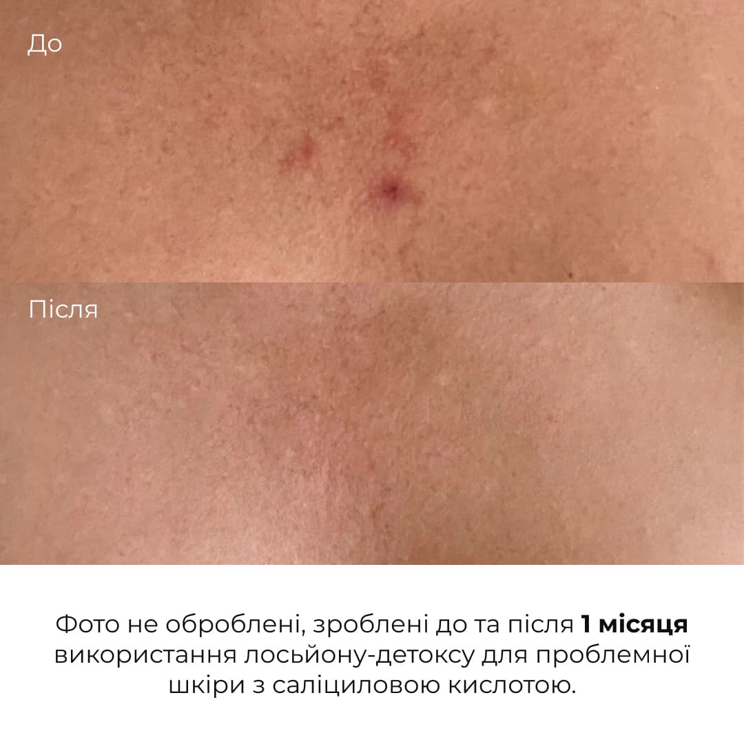 Лосьйон-детокс для проблемної шкіри з саліциловою кислотою, 150 мл thumbnail