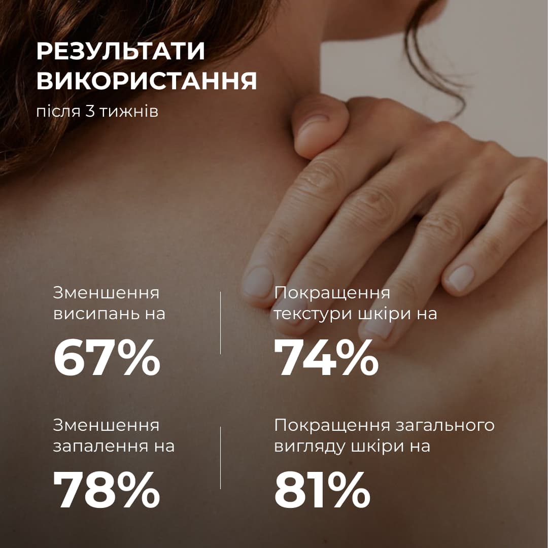 Комплекс "Контроль акне та сонцезахист SPF 50+" для тіла (Hillary) thumbnail