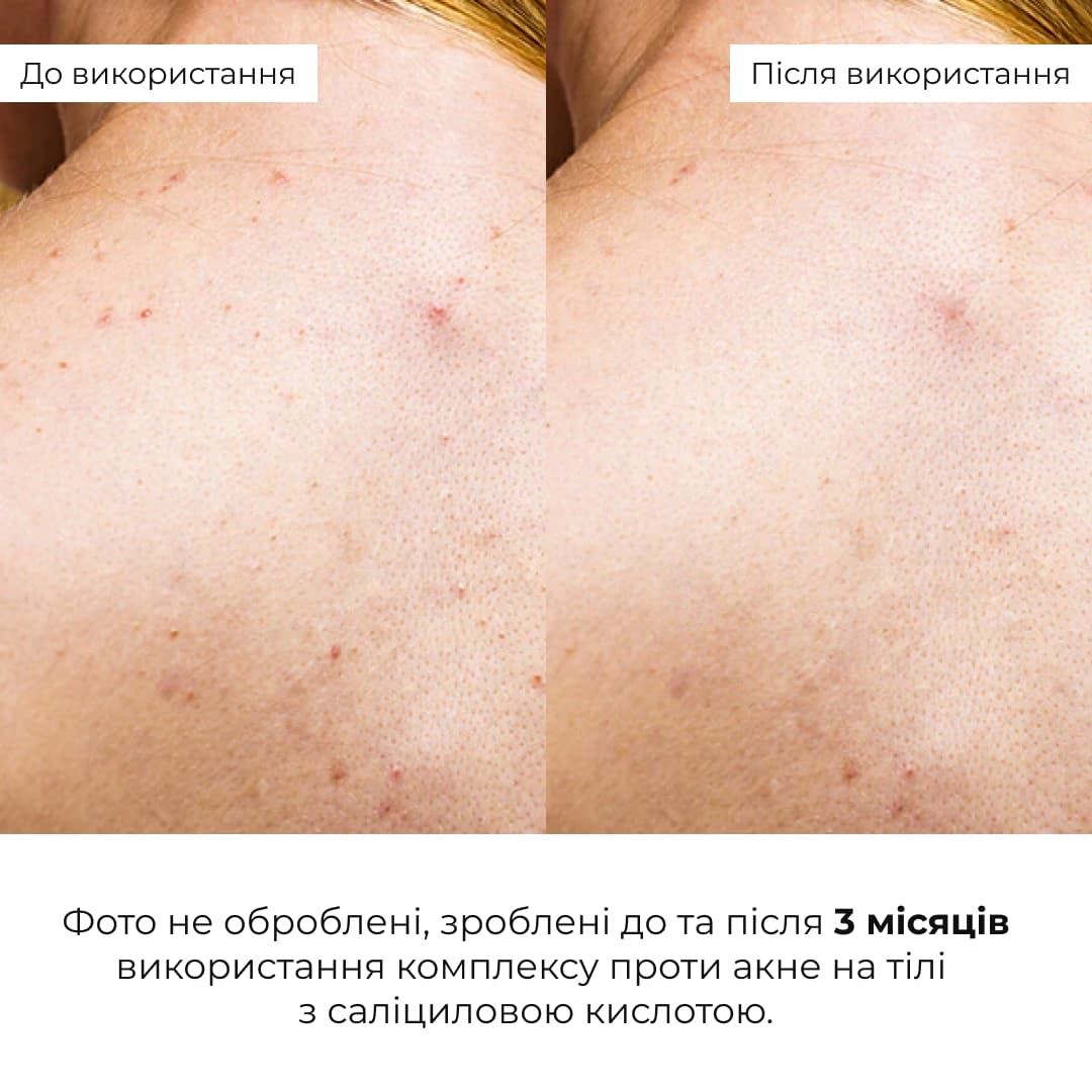 Комплекс "Контроль акне та сонцезахист SPF 50+" для тіла (Hillary) thumbnail