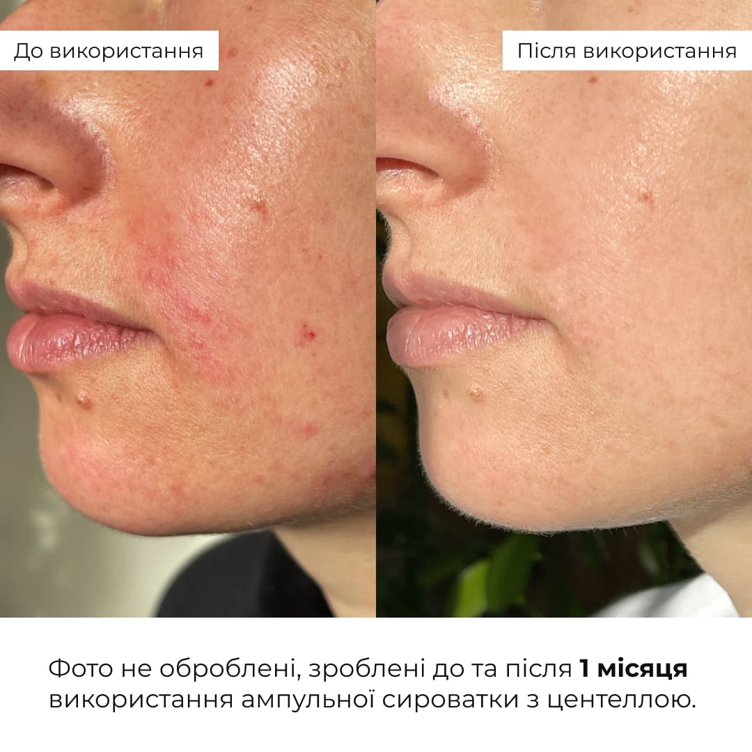 Комплекс з центеллою для заспокоєння та відновлення чутливої шкіри thumbnail