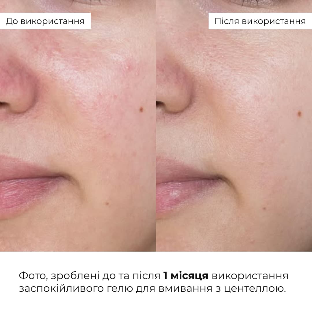 Комплекс з центеллою для заспокоєння та відновлення чутливої шкіри thumbnail