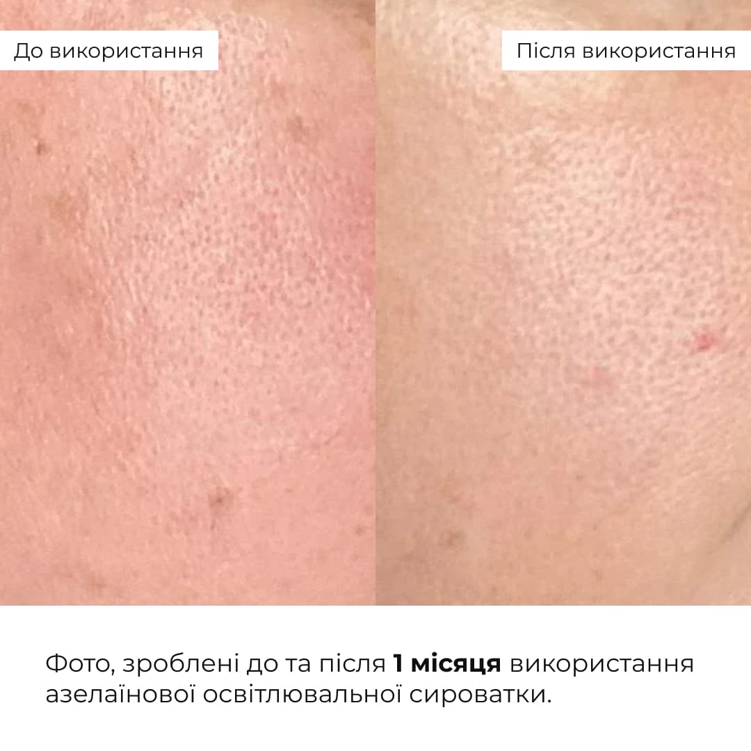 Набір для зволоження та освітлення тону шкіри з азелаїновою кислотою thumbnail