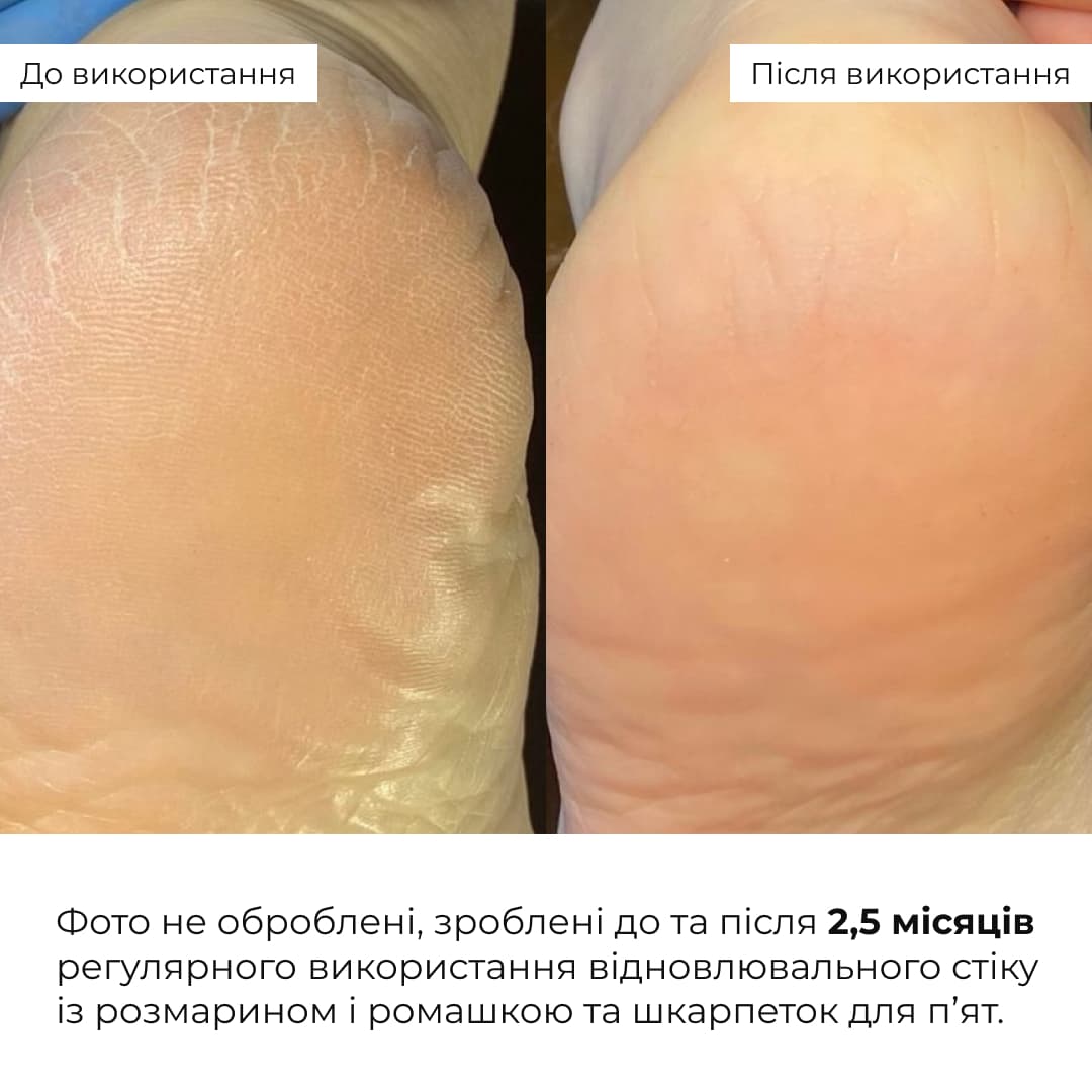 Комплекс для загоєння тріщин та пом'якшення п'ят thumbnail