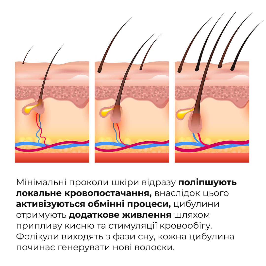 Мезоролер для обличчя thumbnail