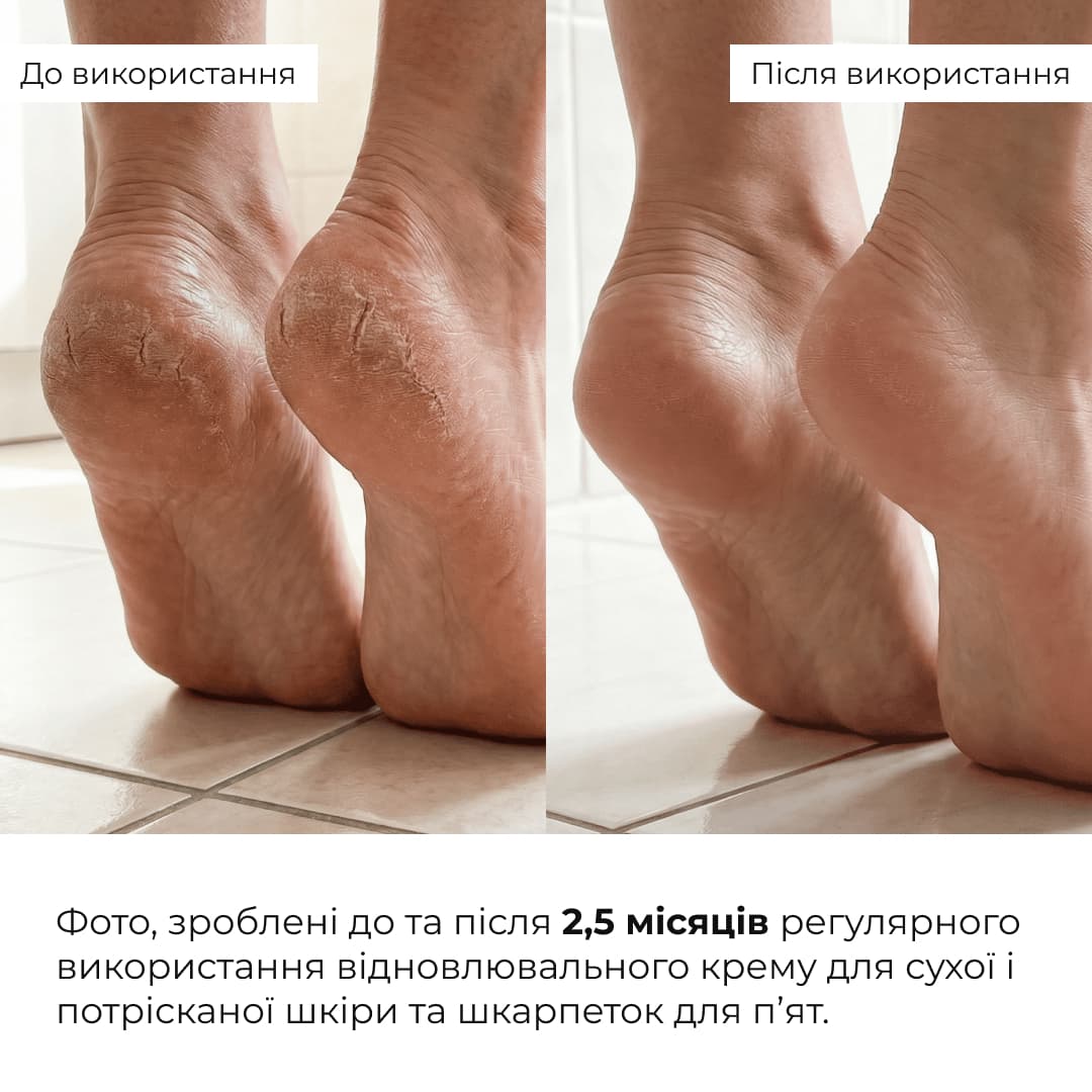 Комплекс для пом'якшення та відновлення потрісканих п'ят thumbnail