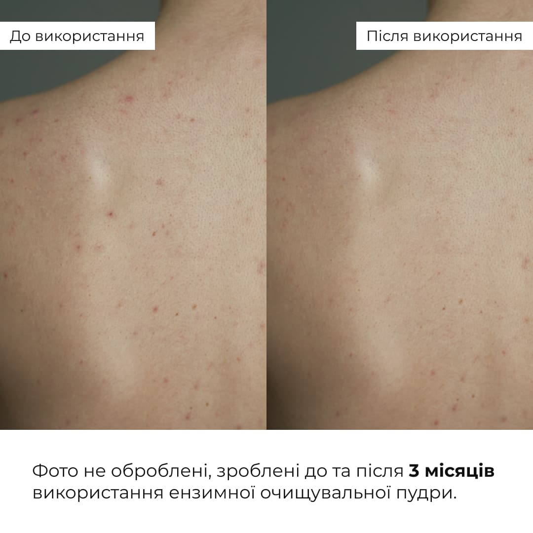 Набір проти жирності та висипань thumbnail